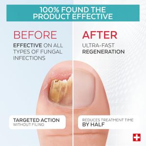 Poderm Anti-Fungal Nail Treatment – Restores and Protects Nails