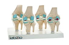 Labzio - 4 Stage Osteoarthritis Anatomical Knee Model, Model On Base, With Detailed Study Guide