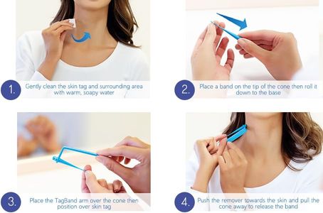 Tagband Skin Tag Remover Kit – Easy At-Home Removal Tool