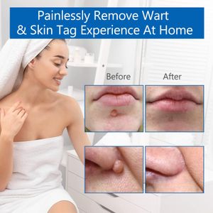 Skin Tag Removal Kit – 2 Pens for Safe, Easy Home Treatment
