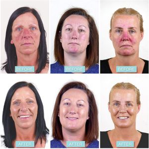 Rosalique 3-in-1 Anti-Redness Colour Corrector SPF50, 30ml – Sensitive Skin