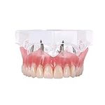 Dentalmall Dental Upper Implants Mo