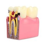 Dental Caries Tooth Model 6 Times D