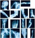 Sayglossy 15 Pcs Broken Bones x Ray Set Human x Rays Black and Blue Skeleton Pretend Xrays for Kids