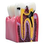 LVCHEN Dental Caries Teeth Model - 
