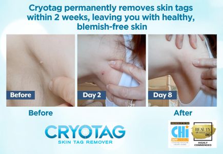 Cryotag Skin Tag Remover – Easy At-Home Skin Tag Removal