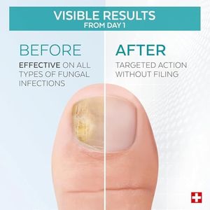 Poderm Purifying Nail Fungus Serum – Pack of 2