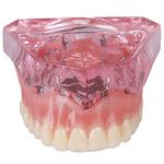 SOARDAY Dental Maxillary Overdenture Model with 4 implants Teaching Study Teeth Model