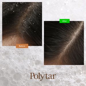 Polytar Scalp Shampoo 150ml – Anti-Dandruff Treatment
