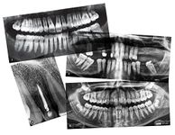 Dental X-Rays