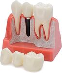 Healthible Dental Implant Model - Implant Vs Bridge Dental Model 4 Times Removable Analysis Crown Bridge Demonstration Teeth Model