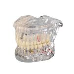 Ultrassist Transparent Disease Teeth Model with Dental Implant Bridge， Dental Model for Patient and Dental Student Education