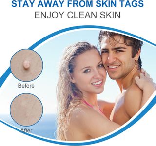 Skin Tag Removal Kit – 2 Pens for Safe, Easy Home Treatment