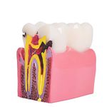 Dental Teeth Model Dental Caries Tooth Model for Patient Education and Explanation