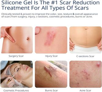 Silicone Scar Gel 30g – Scar Removal Cream for C-Section, Acne, Stretch Marks
